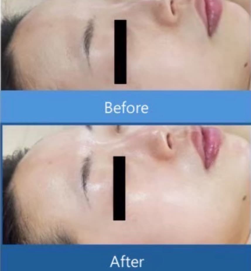 富士市こだわり美肌エステサロンのエクラ・アン・プリュスのダクトピールのビフォー＆アフター写真