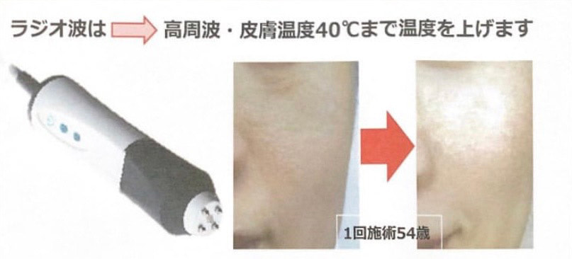 ラジオ波は、高周波・皮膚温度40℃まで温度を上げます