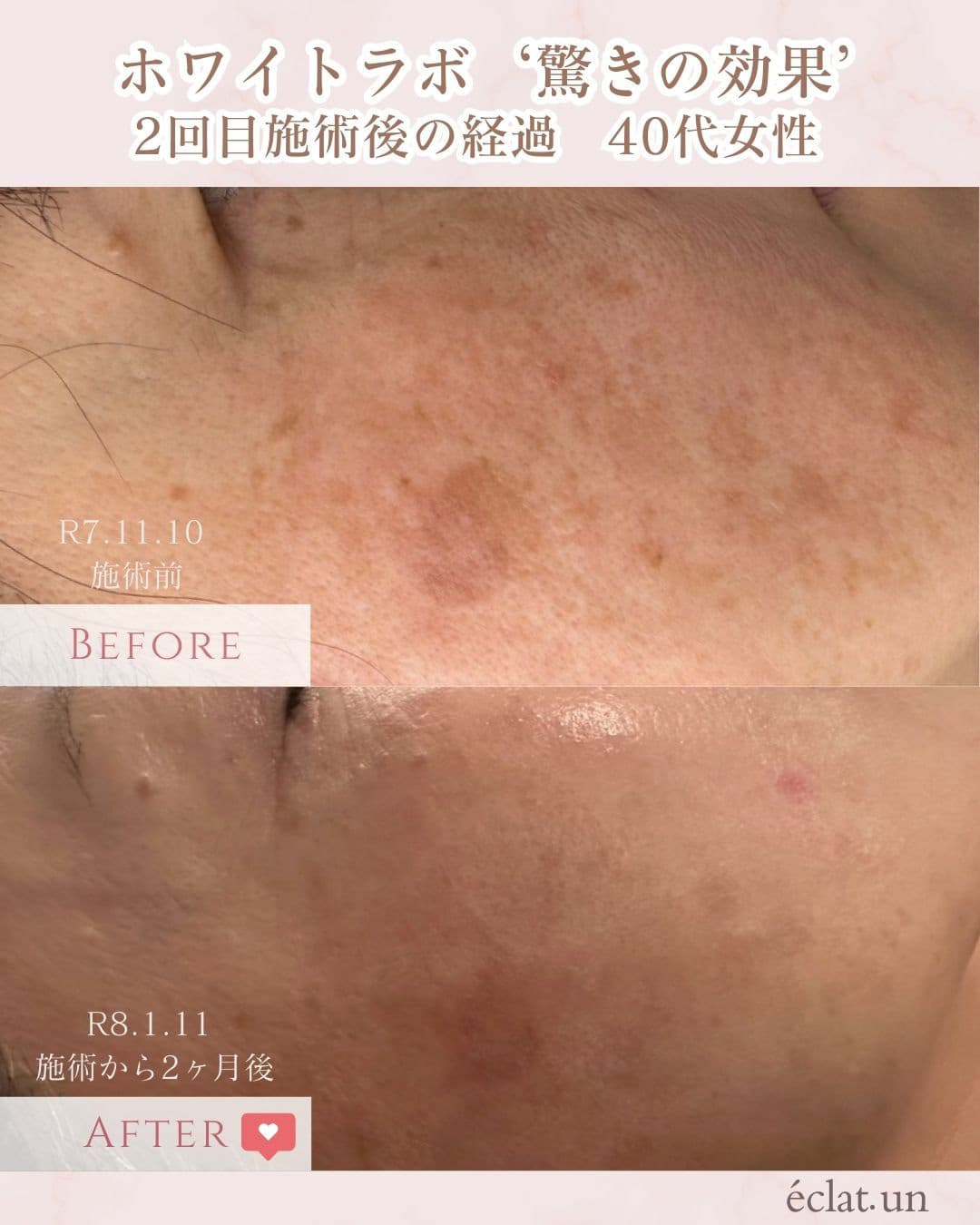富士市美肌サロンのエクラアンプリュスのホワイトラボビフォーアフター驚きの効果２回目施術後の経過・40歳代女性