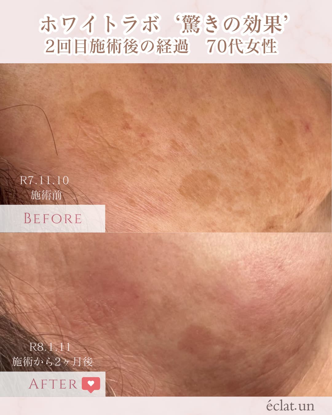 富士市美肌サロンのエクラアンプリュスのホワイトラボビフォーアフター驚きの効果２回目施術後の経過・70歳代女性