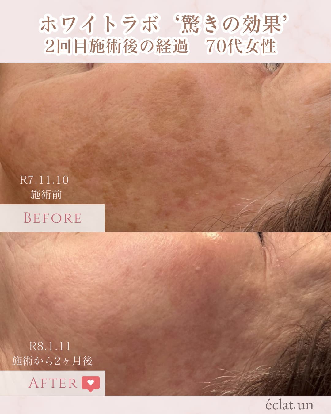 富士市美肌サロンのエクラアンプリュスのホワイトラボビフォーアフター驚きの効果２回目施術後の経過・70歳代女性