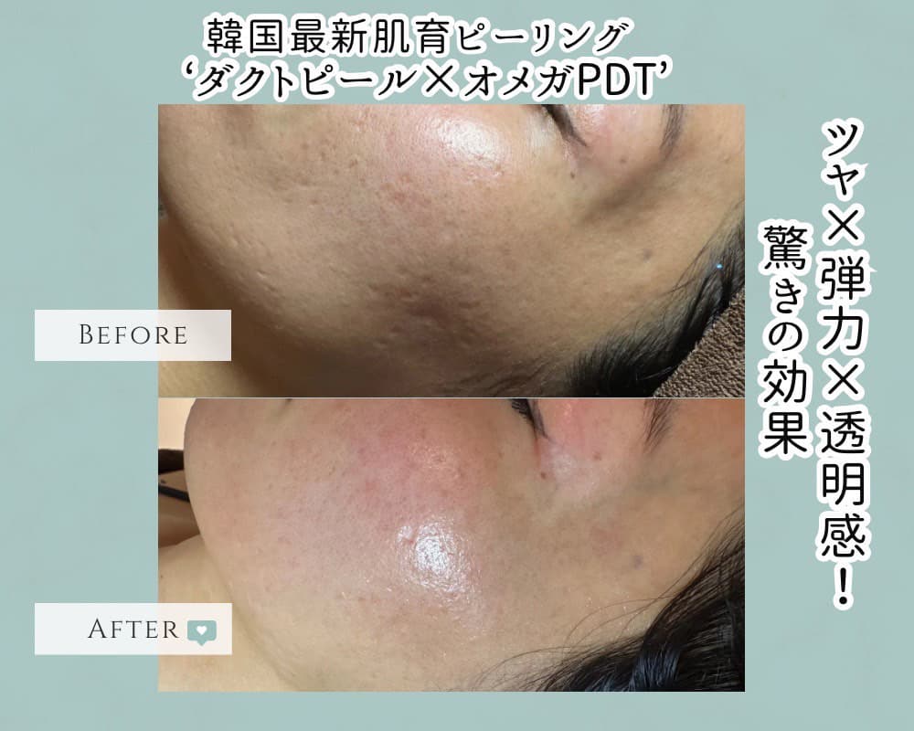富士市こだわり美肌エステサロンのエクラ・アン・プリュスのダクトピールのビフォー＆アフター写真韓国最新肌育ピーリング‘ダクトピール×オメガPDT’ツヤ×弾力×透明感！驚きの効果