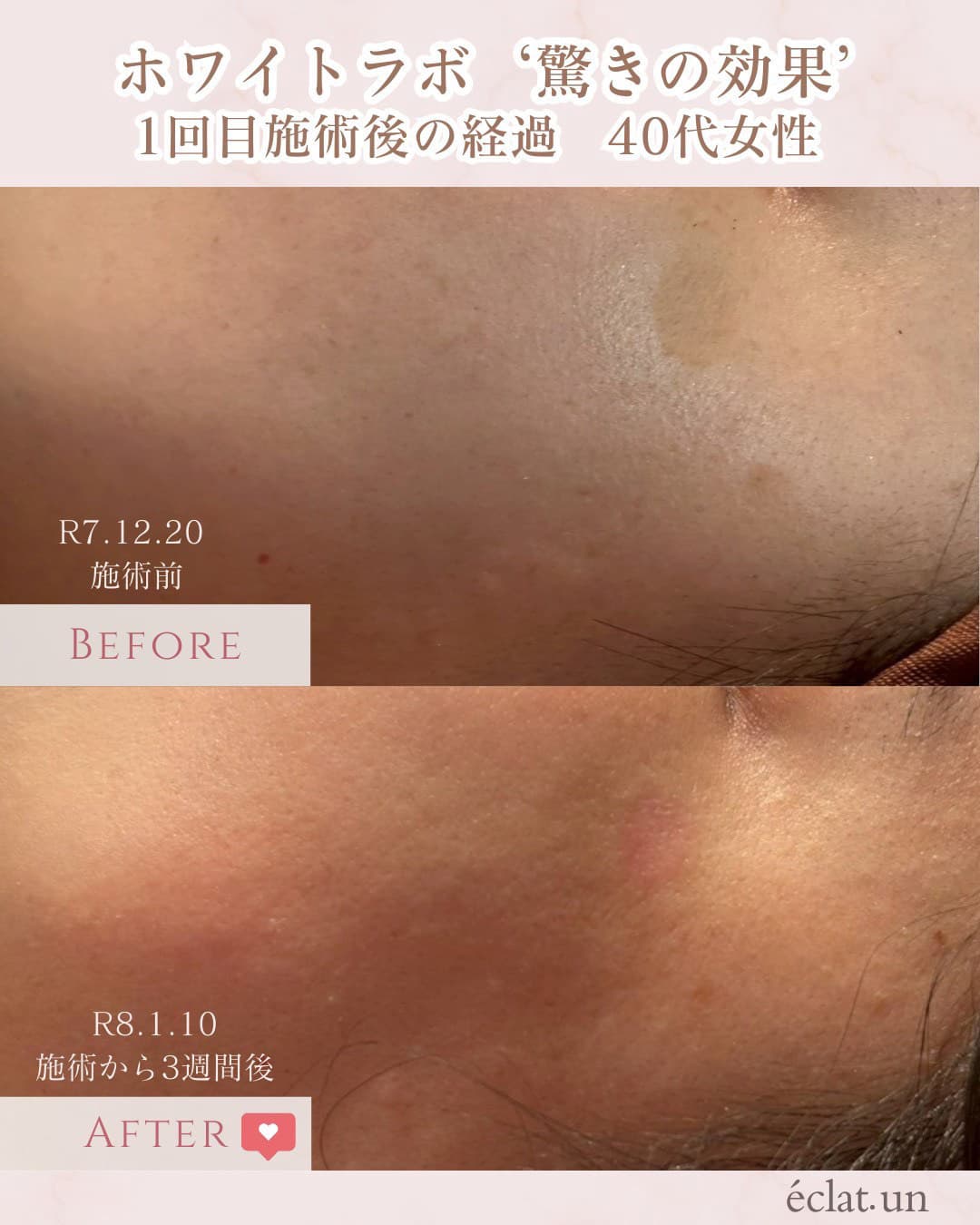 富士市美肌サロンのエクラアンプリュスのホワイトラボビフォーアフター驚きの効果１回目施術後の経過・40歳代女性