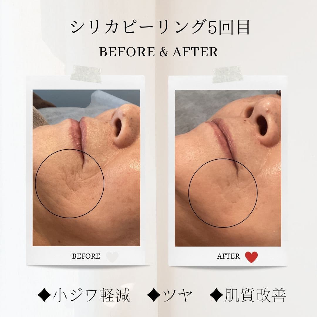 富士市美肌サロンのエクラアンプリュスのお客様ビフォーアフター・シリカピーリング５回目（小ジワ軽減・ツヤ・肌質改善）