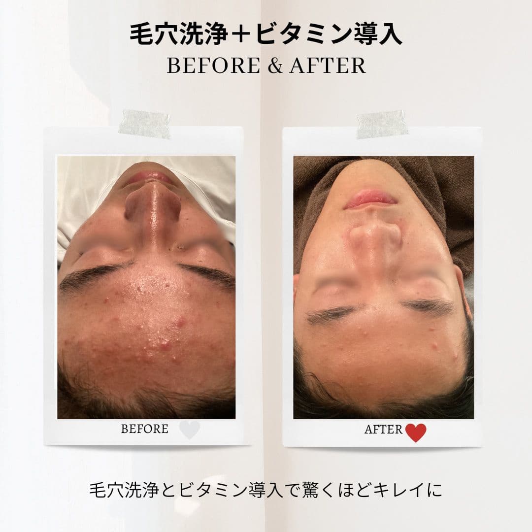 富士市美肌サロンのエクラアンプリュスのお客様ビフォーアフター・毛穴洗浄＋ビタミン導入・毛穴洗浄とビタミン導入で驚くほどキレイに