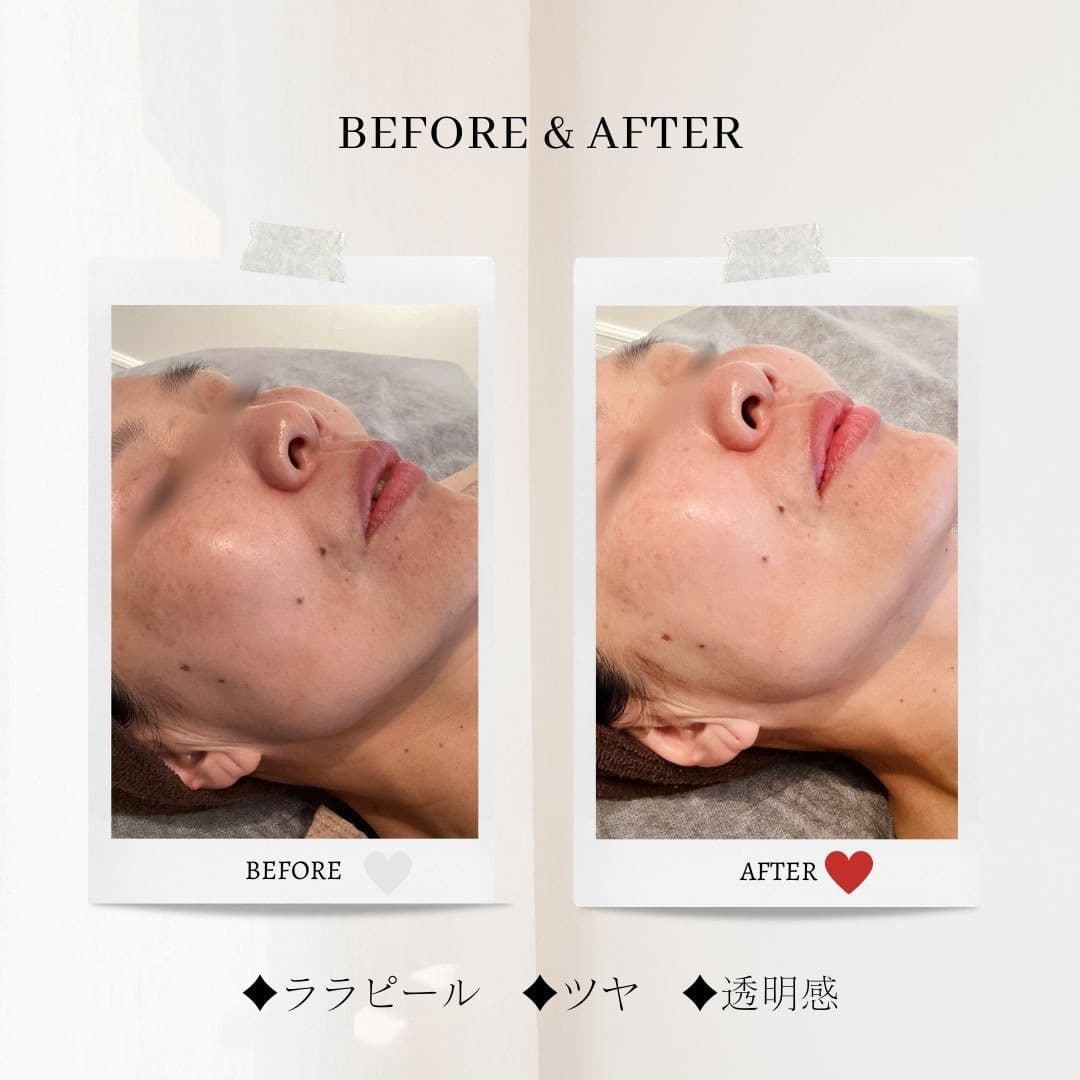 富士市美肌サロンのエクラアンプリュスのお客様ビフォーアフター（ララピール・ツヤ・透明感）