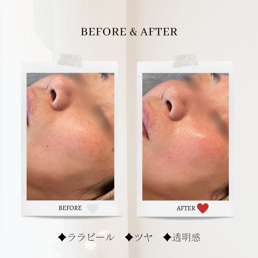 富士市美肌サロンのエクラアンプリュスのお客様ビフォーアフター（ララピール・ツヤ・透明感）