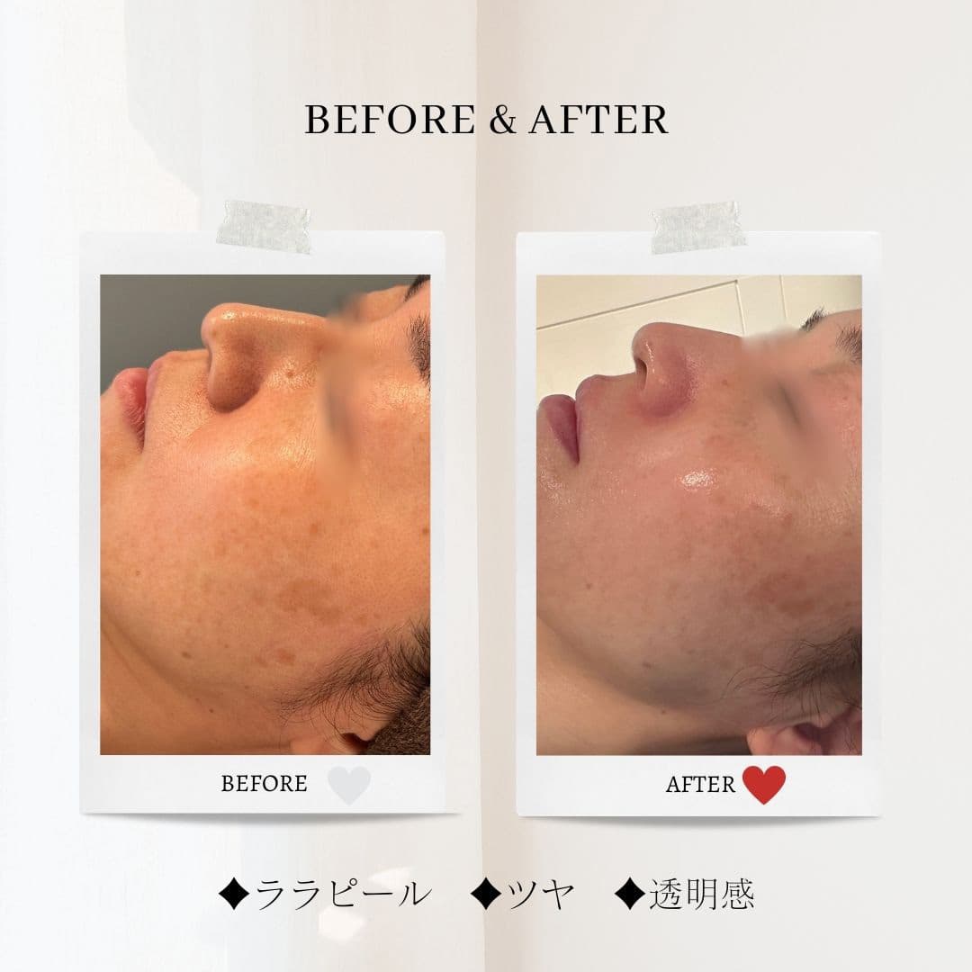 富士市美肌サロンのエクラアンプリュスのお客様ビフォーアフター（ララピール・ツヤ・透明感）