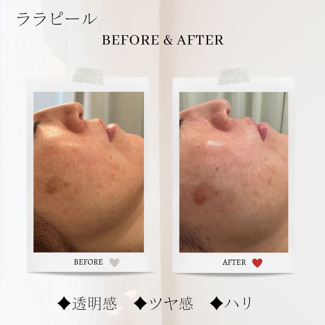 富士市美肌サロンのエクラアンプリュスのお客様ビフォーアフター（ララピール・透明感・ツヤ感・ハリ）