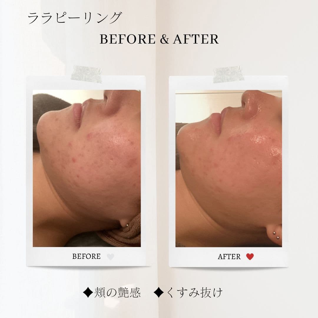 富士市美肌サロンのエクラアンプリュスのお客様ビフォーアフター（ララピーリング・頬の艶感・くすみ抜け）
