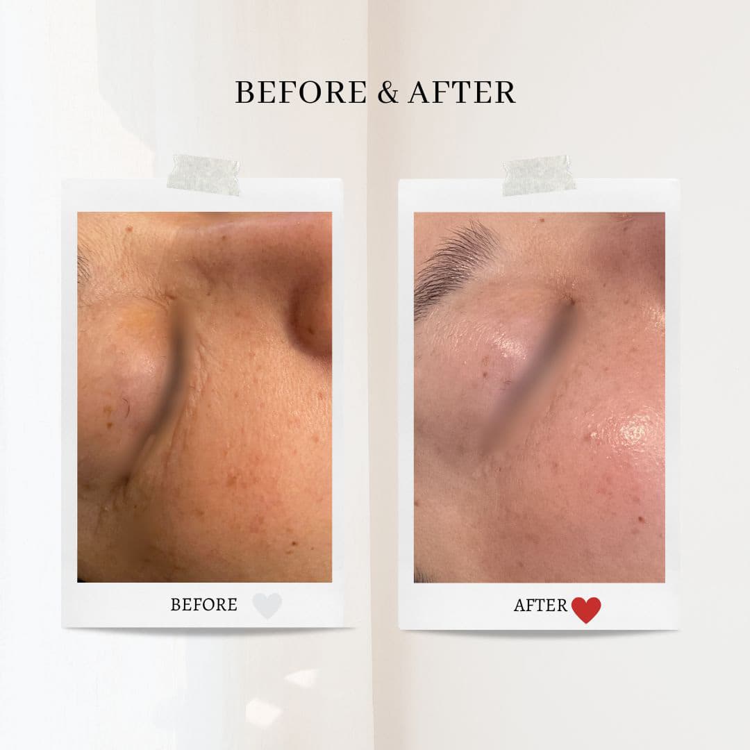 富士市美肌サロンのエクラアンプリュスのお客様ビフォーアフター