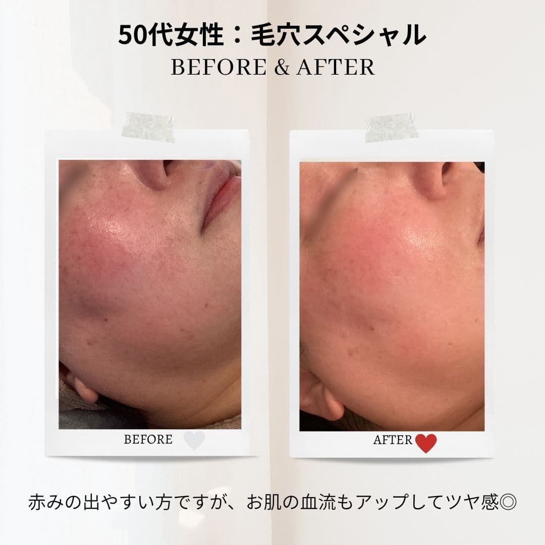 富士市美肌サロンのエクラアンプリュスのお客様ビフォーアフター・50代女性：毛穴スペシャル・赤みの出やすい方ですが、お肌の血流もアップしてツヤ感◎
