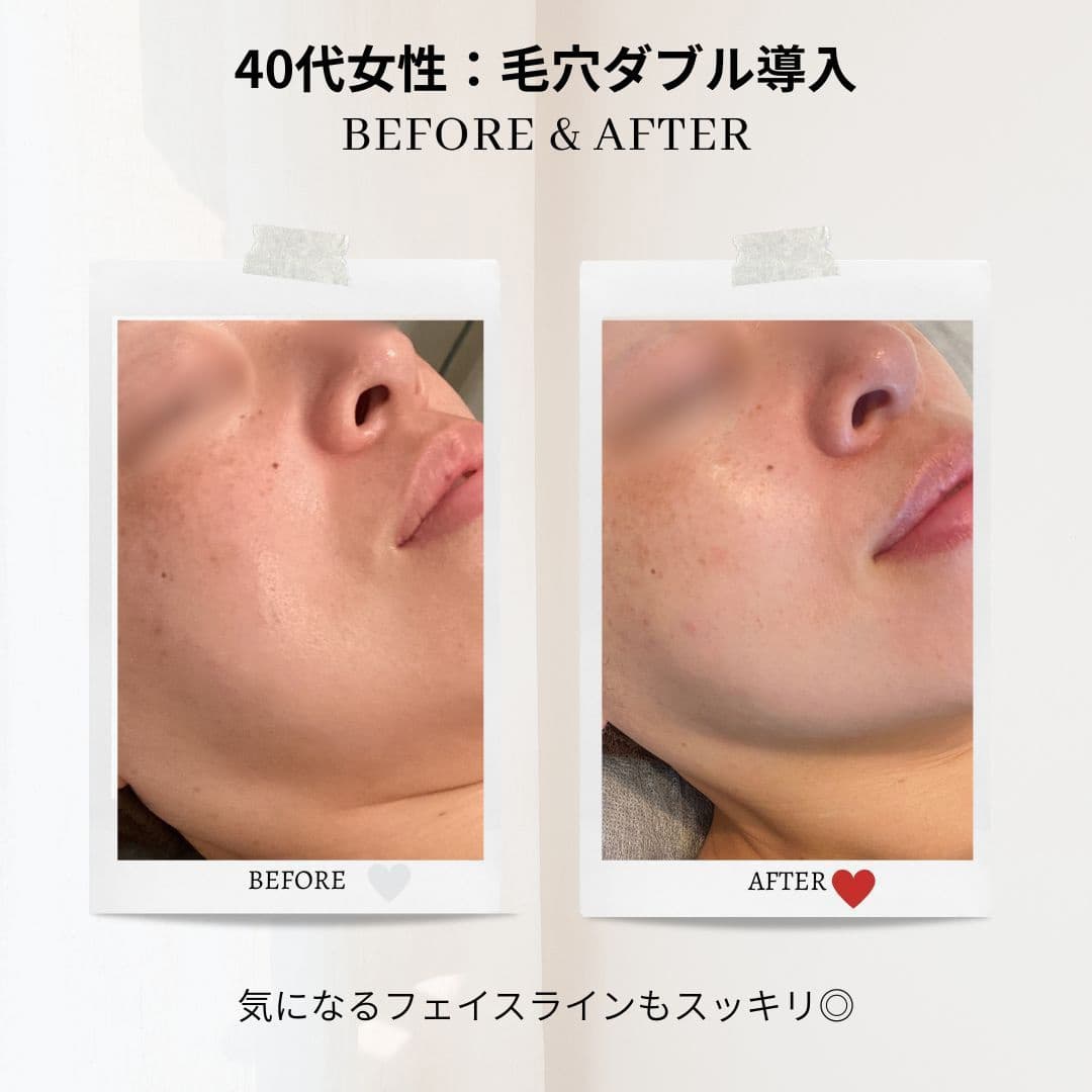 富士市美肌サロンのエクラアンプリュスのお客様ビフォーアフター・40代女性：毛穴ダブル導入・気になるフェイスラインもスッキリ◎