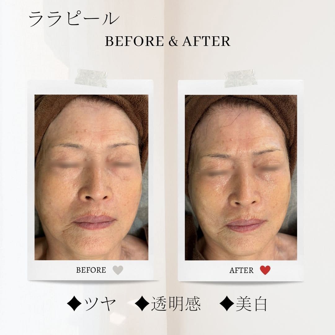 富士市美肌サロンのエクラアンプリュスのお客様ビフォーアフター（ララピール・ツヤ・透明感・美白）