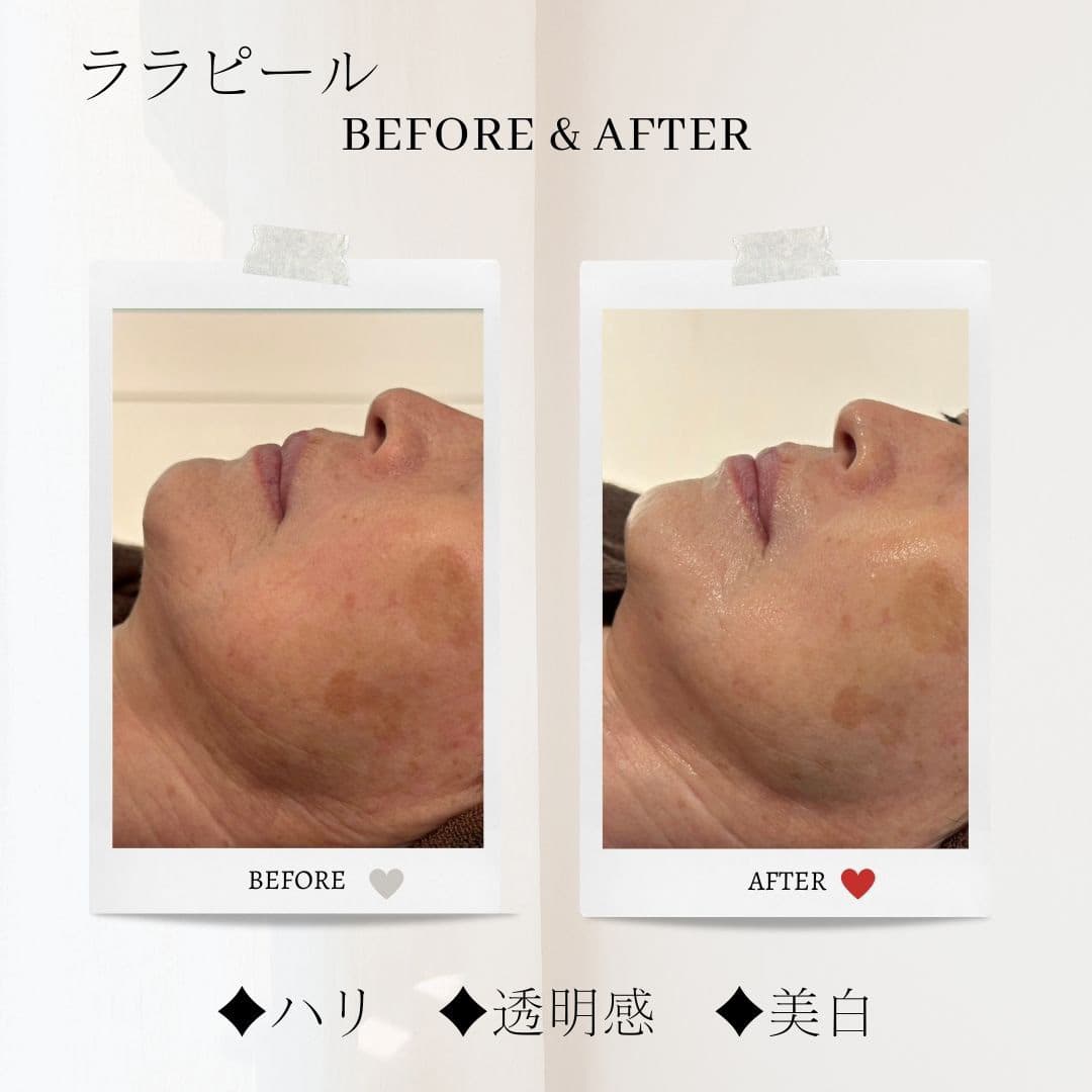 富士市美肌サロンのエクラアンプリュスのお客様ビフォーアフター（ララピール・ハリ・透明感・美白）