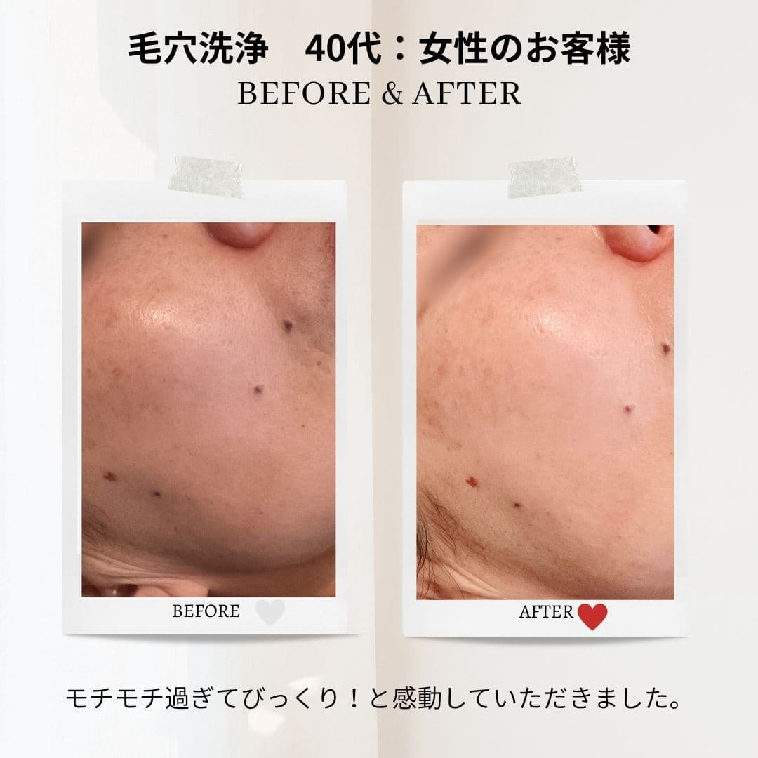富士市美肌サロンのエクラアンプリュスのお客様ビフォーアフター・毛穴洗浄40代：女性のお客様・モチモチ過ぎてびっくり！と感動していただきました。