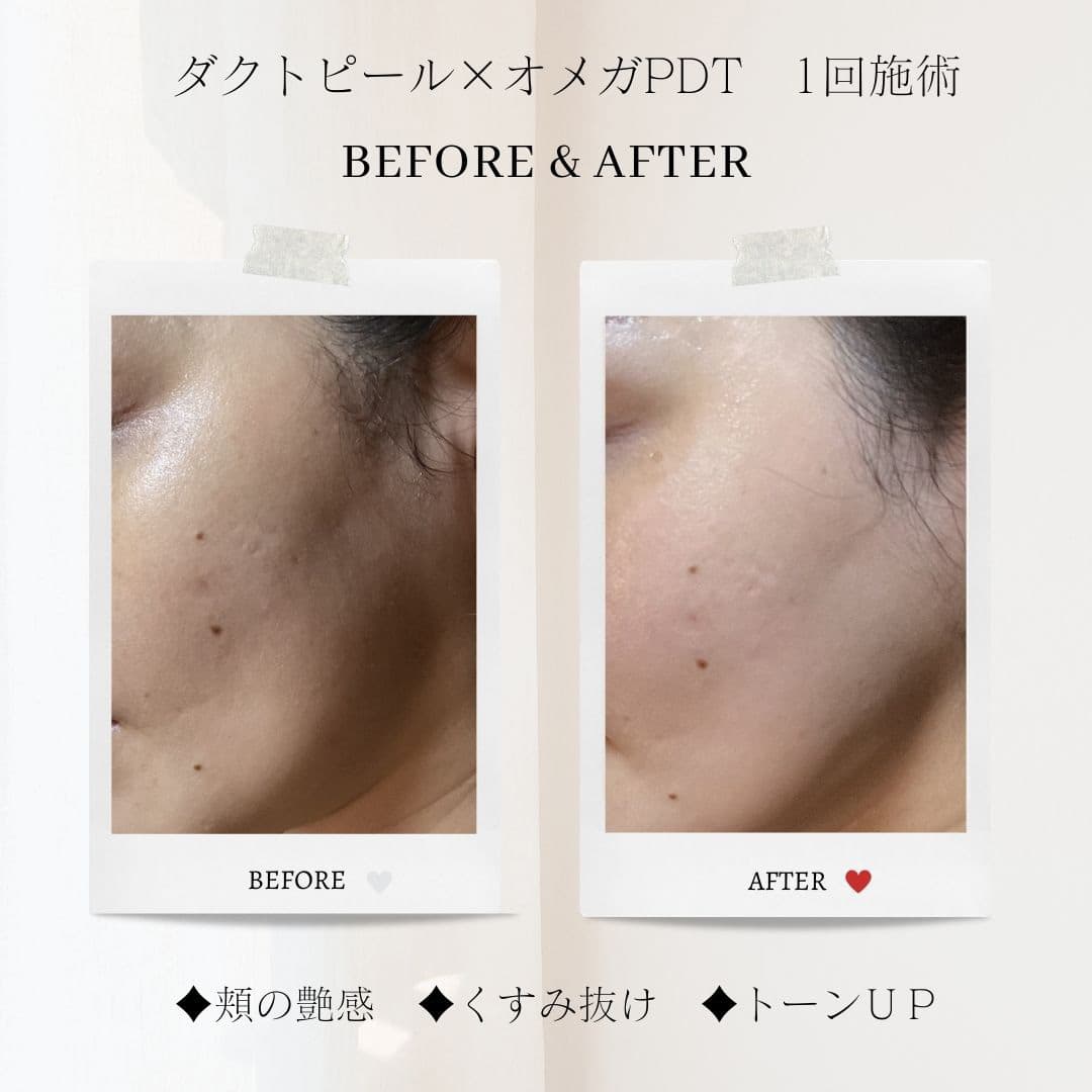 富士市美肌サロンのエクラアンプリュスのお客様ビフォーアフター（ダクトヒール×オメガPDT１回施術・頬の艶感・くすみ抜け・トーンＵＰ）