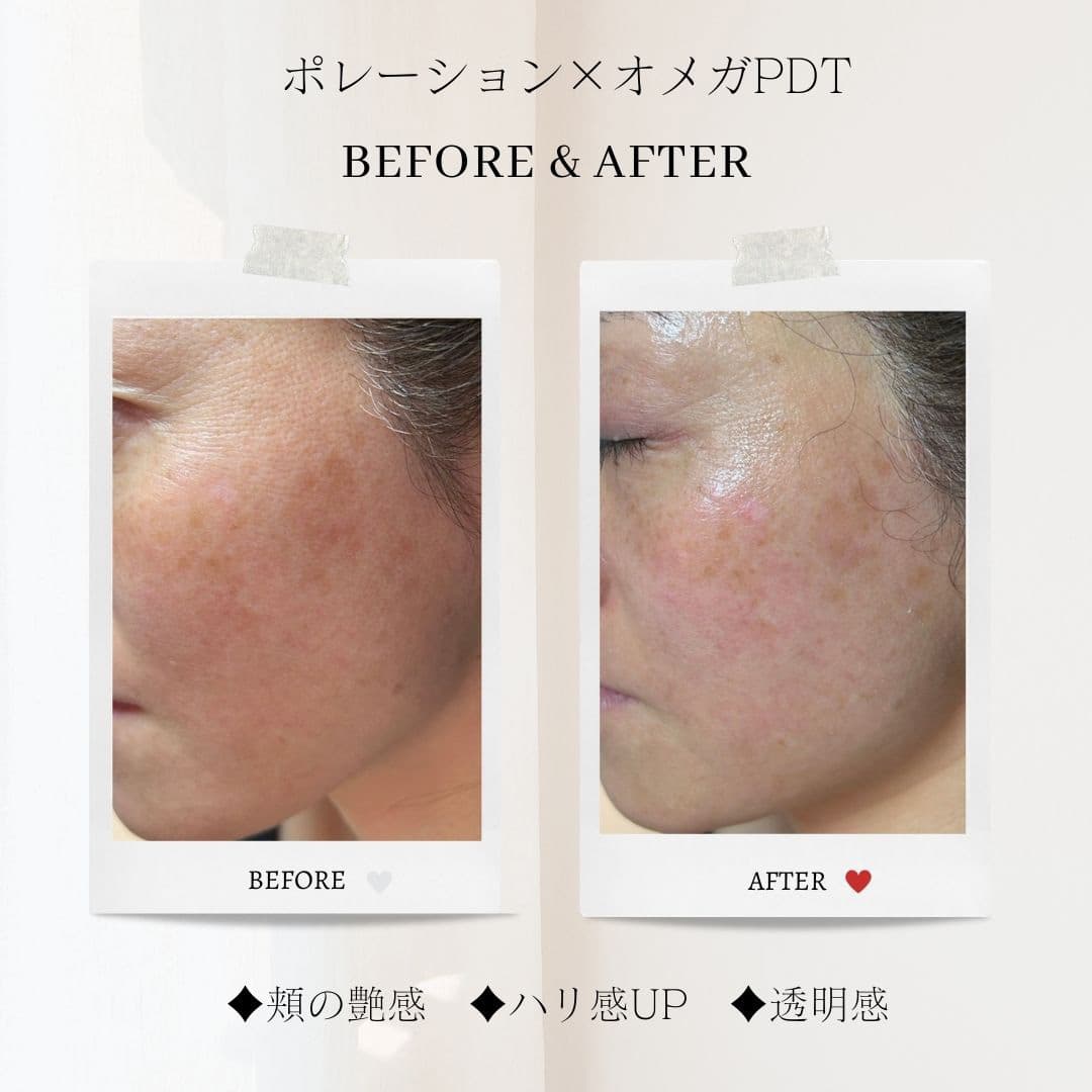富士市美肌サロンのエクラアンプリュスのお客様ビフォーアフター（ポレーション×オメガPDT・頬の艶感・ハリ感アップ・透明感）
