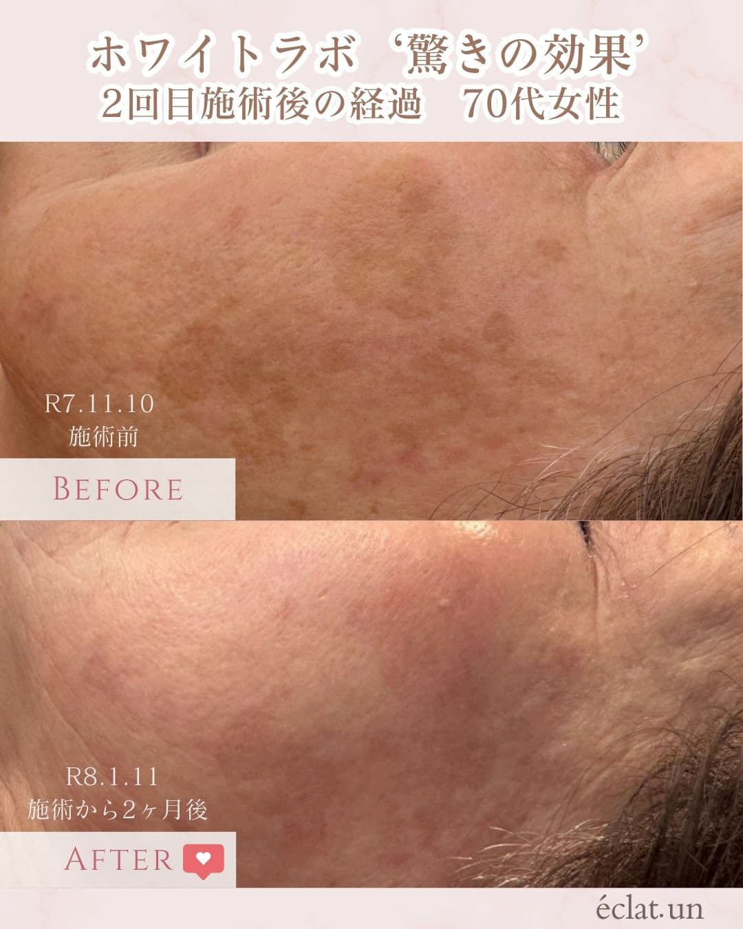 富士市美肌サロンのエクラアンプリュスのお客様ビフォーアフター（ホワイトラボ・驚きの効果・２回目施術後の経過・70代女性）