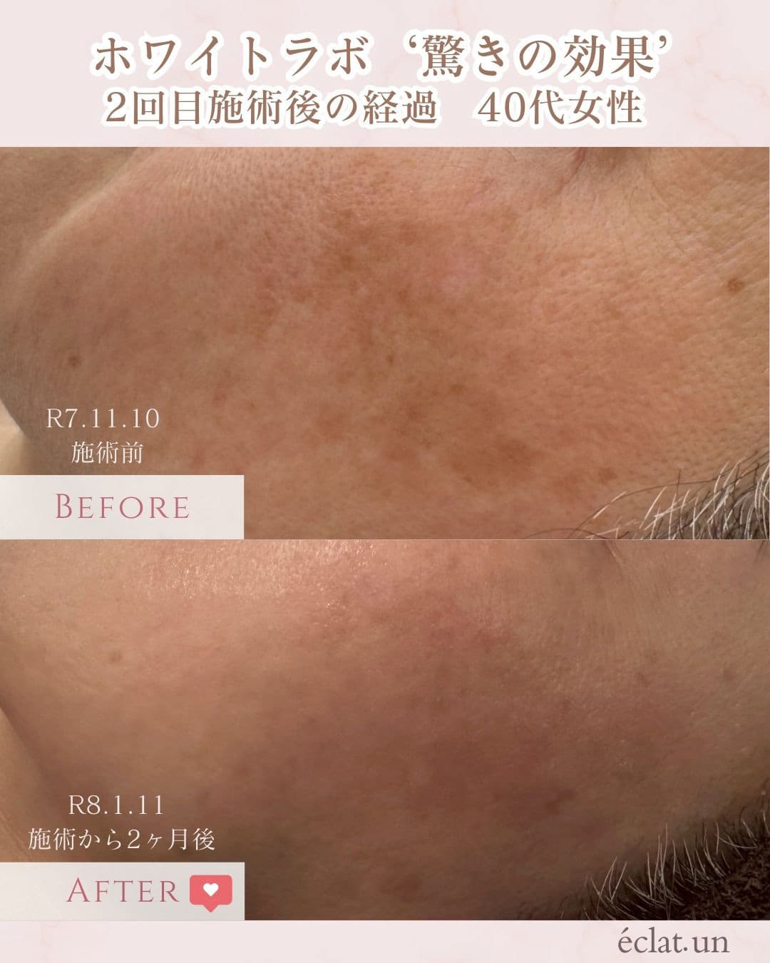 富士市美肌サロンのエクラアンプリュスのお客様ビフォーアフター（ホワイトラボ・驚きの効果・２回目施術後の経過・40代女性）