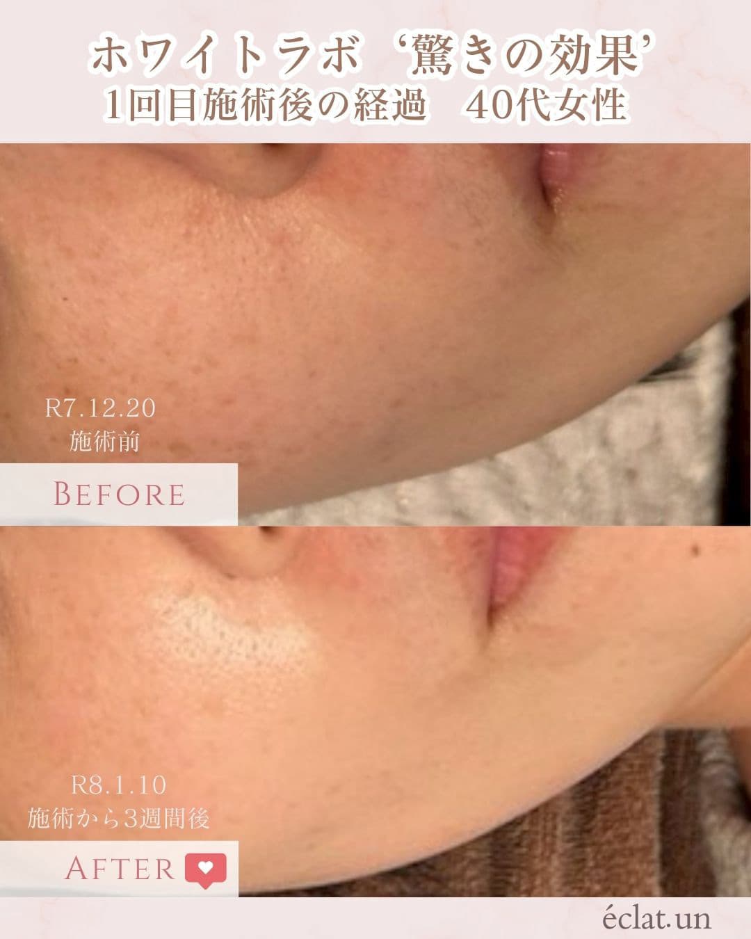 富士市美肌サロンのエクラアンプリュスのお客様ビフォーアフター（ホワイトラボ・驚きの効果・１回目施術後の経過・40代女性）